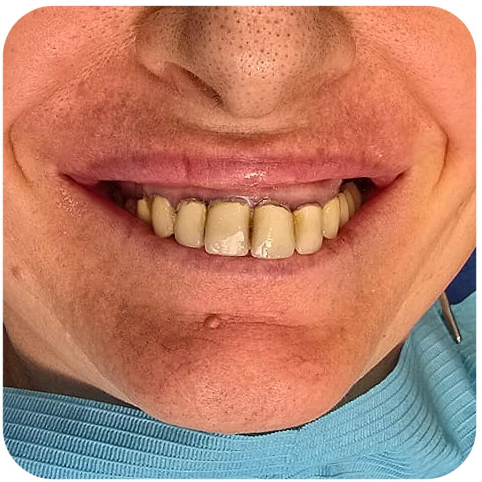 Prima del Trattamento 5